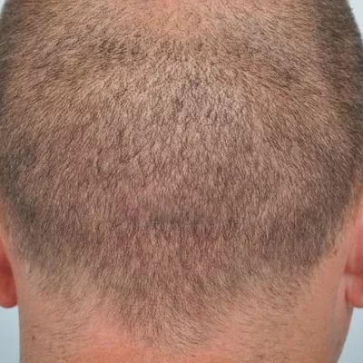 زراعة الشعر بدون ندبات في الرياض والسعودية وجدة