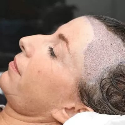 زراعة الشعر للسيدات في الرياض والسعودية وجدة يكلف