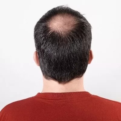 علاج الصلع للرجال في الرياض والسعودية وجدة يكلف