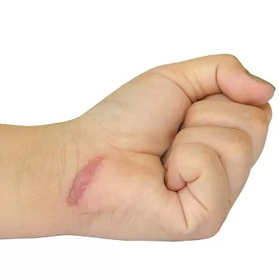 علاج الندبات المتضخمة في الرياض والسعودية وجدة يكلف
