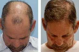 أفضل عيادة ترميم الشعر بالرياض