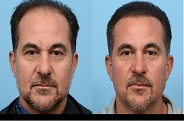 ترميم الشعر بالرياض