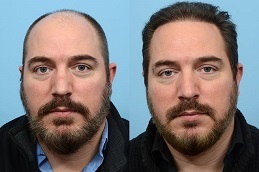 ترميم الشعرالرياض