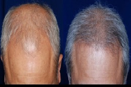 تكلفة ترميم الشعر بالرياض