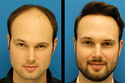 تكلفة ترميم الشعر بالرياض