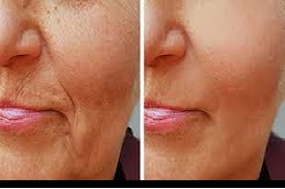 أفضل الوخز بالإبر الدقيقة مع (PRP) في الرياض.