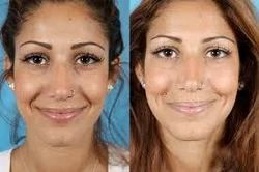 أفضل خلق الدمل في الرياض