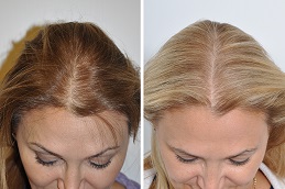 أفضل زراعة الشعر للسيدات في رياض