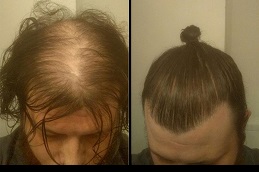 أفضل علاج الصلع للرجال في الرياض