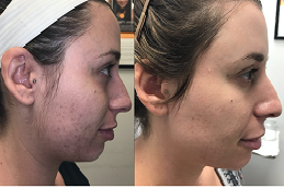 أفضل عيادة الوخز بالإبر الدقيقة مع (PRP) في الرياض.