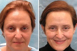 أفضل عيادة زراعة الشعر للسيدات في رياض