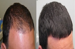 أفضل عيادة علاج الصلع للرجال في الرياض