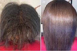 أفضل عيادة فيلر الشعر في الرياض