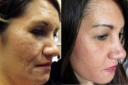 الوخز بالإبر الدقيقة مع (PRP) الرياض.