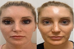 الوخز بالإبر الدقيقة مع (PRP) في الرياض.