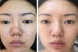 تكلفة الوخز بالإبر الدقيقة مع (PRP) في الرياض.