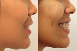 تكلفة خلق الدمل في الرياض