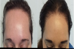 تكلفة زراعة الشعر للسيدات في رياض