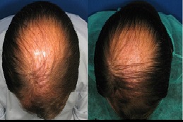 تكلفة علاج الصلع للرجال في الرياض