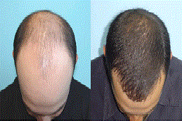 علاج الصلع للرجال الرياض