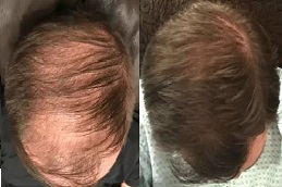 علاج الصلع للرجال في الرياض