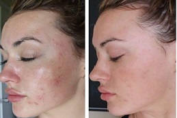 عيادة الوخز بالإبر الدقيقة مع (PRP) في الرياض.