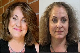 عيادة زراعة الشعر للسيدات في رياض