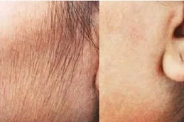أفضل تبييض الشعر بالليزر الرياض