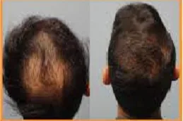 أفضل تكلفة زراعة الشعر الرياض