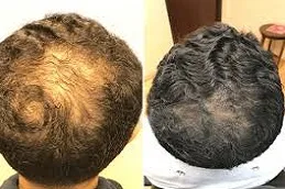 أفضل تكلفة زراعة الشعر في الرياض