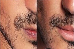 أفضل علاج شفاه المدخن في الرياض