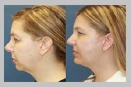 تجديد شباب الوجه الرياض