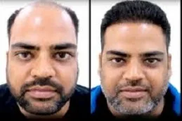 تكلفة زراعة الشعر الرياض