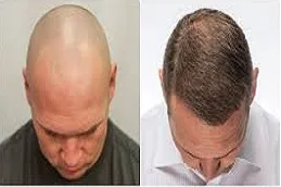 تكلفة زراعة الشعر في الرياض