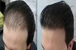 تكلفة علاج زراعة الشعر في الرياض