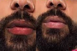 تكلفة علاج شفاه المدخن في الرياض