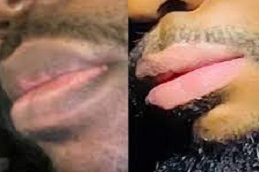 علاج شفاه المدخن الرياض