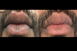 علاج شفاه المدخن في الرياض