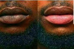 عيادة علاج شفاه المدخن بالرياض