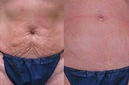 أفضل العلاج بالاهتزاز برويليكس الرياض