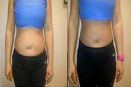 أفضل العلاج بالاهتزاز برويليكس في الرياض