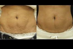 العلاج بالاهتزاز برويليكس في الرياض