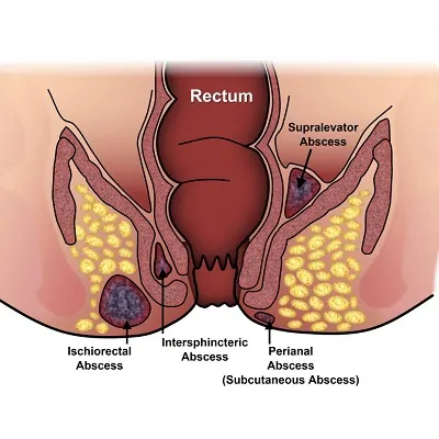 جراحة الناسور في الرياض
