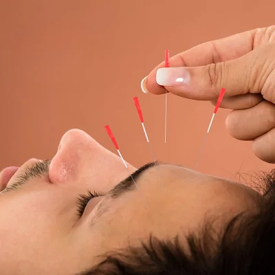 علاج الوخز بالإبر الصينية في الرياض