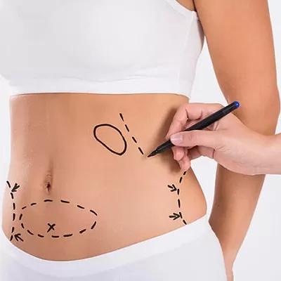 عملية شفط الدهون وشد البطن في الرياض