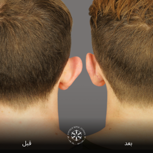 جراحة تجميل الأذن (2)