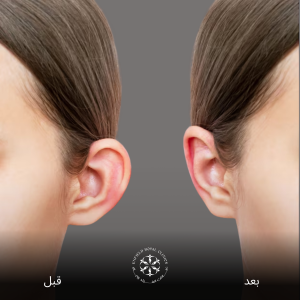 جراحة تجميل الأذن في الرياض