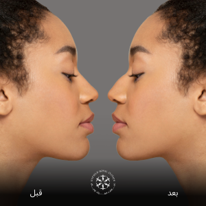 جراحة تجميل الأنف في الرياض