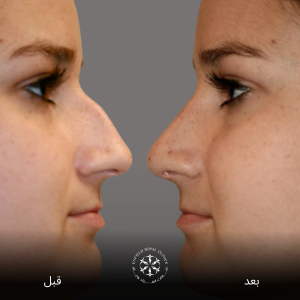 جراحة تجميل الأنف ما قبل وما بعد