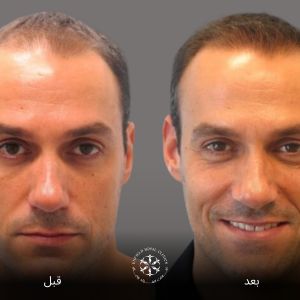 زراعة الشعر